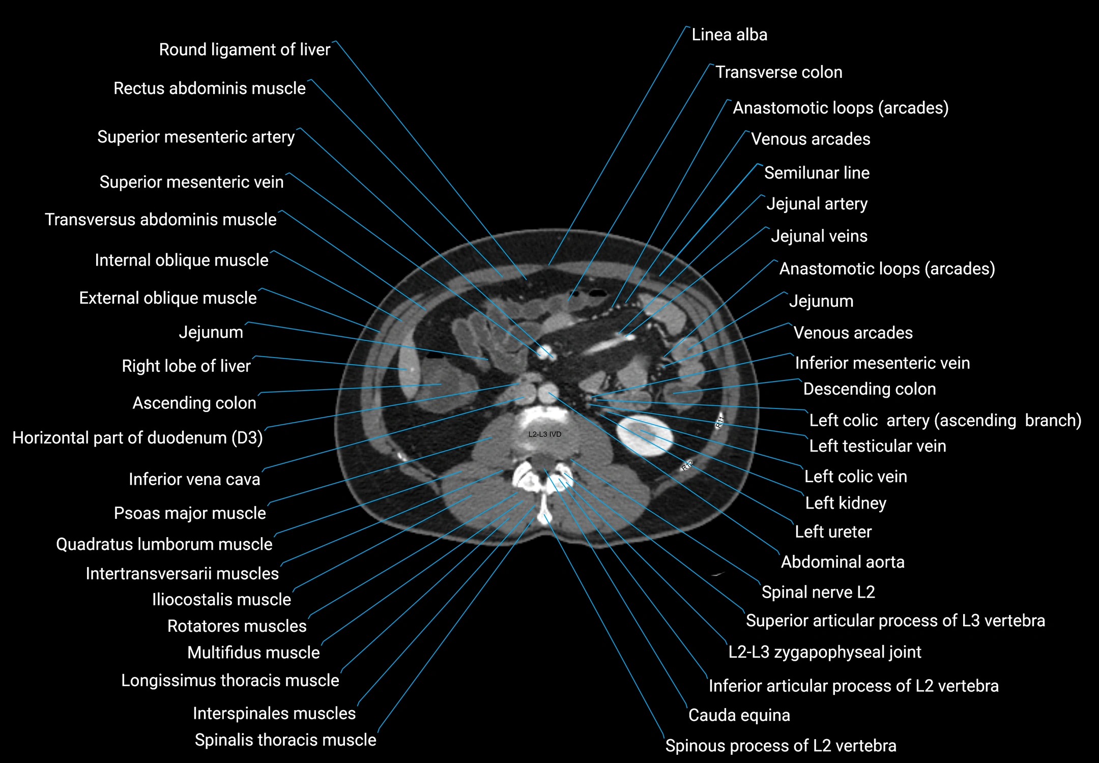 CT male pelvis axial cross sectional anatomy labelled radiology image -00084.webp